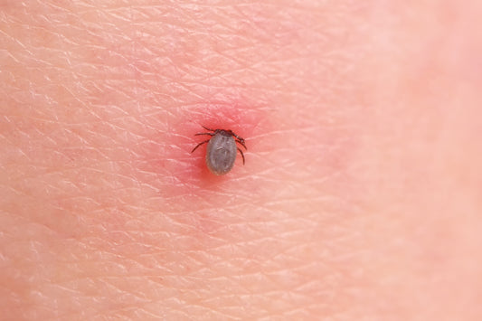 How to stop ticks biting, Lyme disease prevention